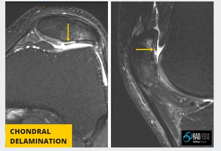 Chondral Delamination MRI: Quick Review - Radedasia
