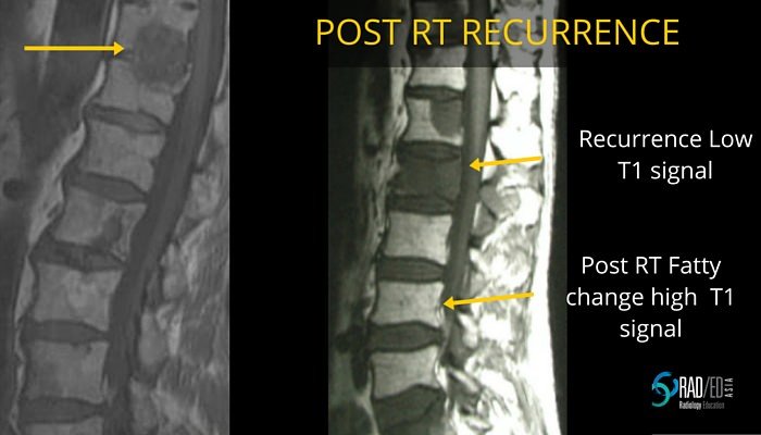 radiation spine, mri-radiology-education-asia-radedasia