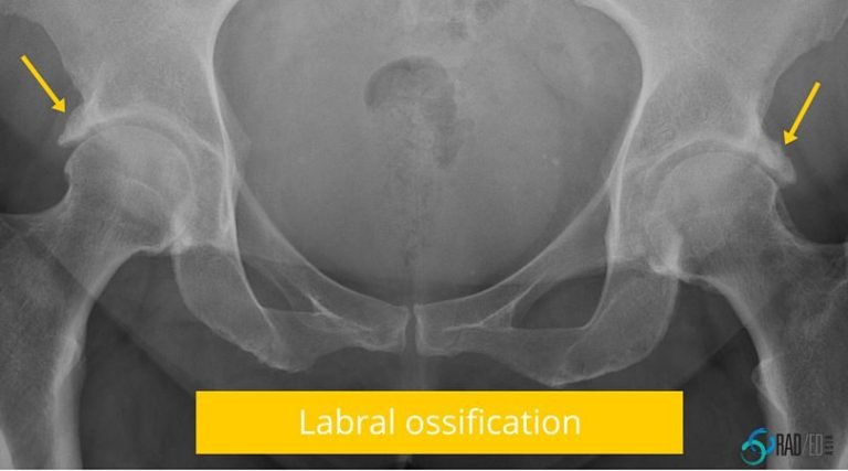 hip fai labral ossification radiology education asia radedasia