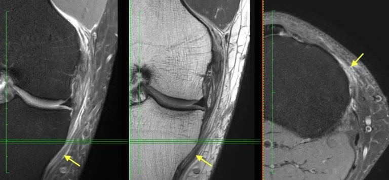 mri knee mcl medial collateral ligament stripping tear radiology education asia