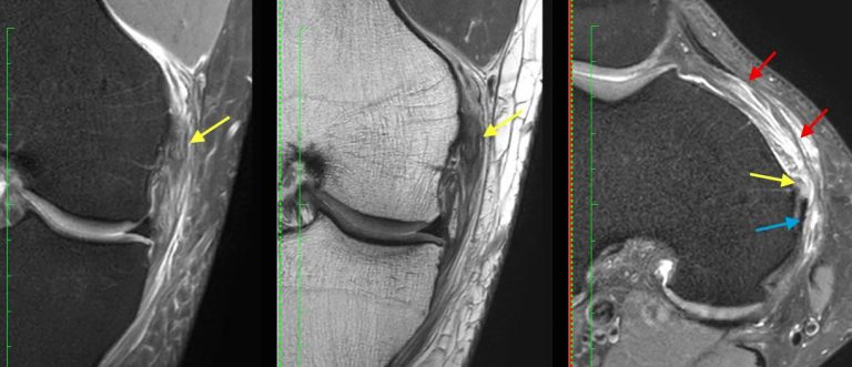 MRI Knee MCL Tear What Else To Look For Radiology Education Asia