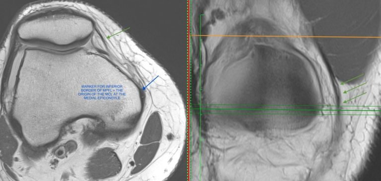 mri knee patella dislocation mpfl radiology education asia