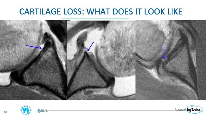 shoulder-labrum-mri-glenoid-cartilage-radedasia