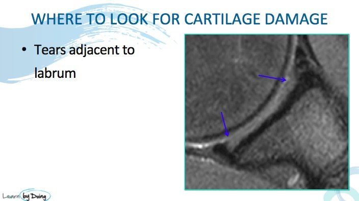 Shoulder Labrum Mri Glenoid Cartilage Radedasia