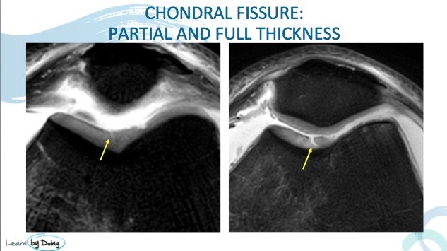 mri-cartilage-radedasia