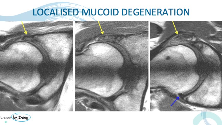 Hip Labrum Mri Anatomy