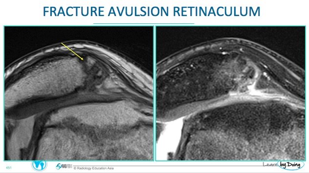 Knee MRI Patella Dislocation | Radedasia