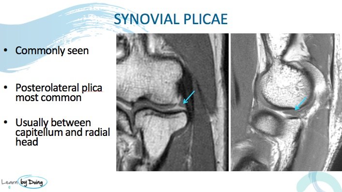 Elbow Joints Normal Variants on MRI - Radedasia