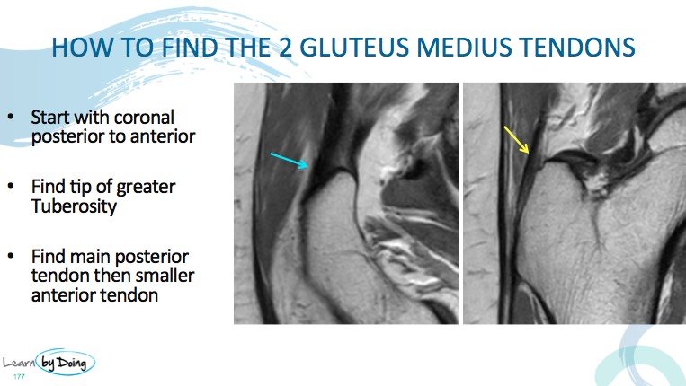 MRI Hip Gluteal Tendon Anatomy Radedasia