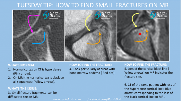 mri fracture how to find radiology education asia tuesday tip