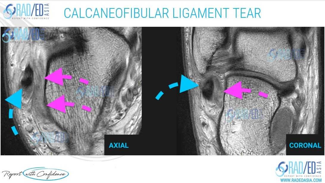 ankle mri ligaments cfl calcaneofibular report radedasia