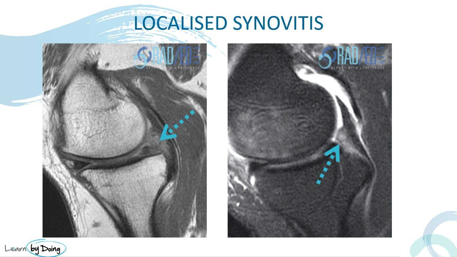 mri synovitis knee localised radedasia