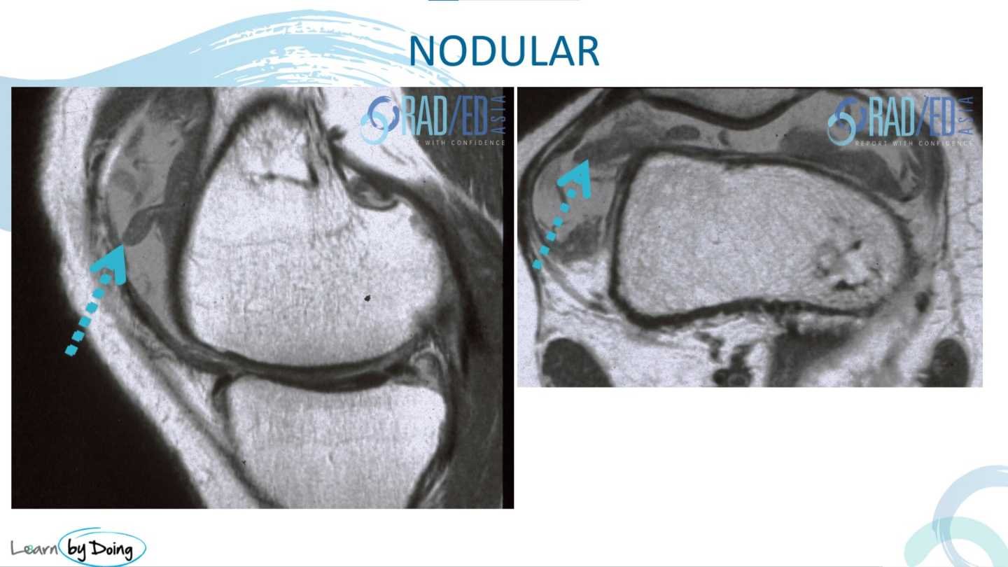 mri synovitis knee nodular radedasia