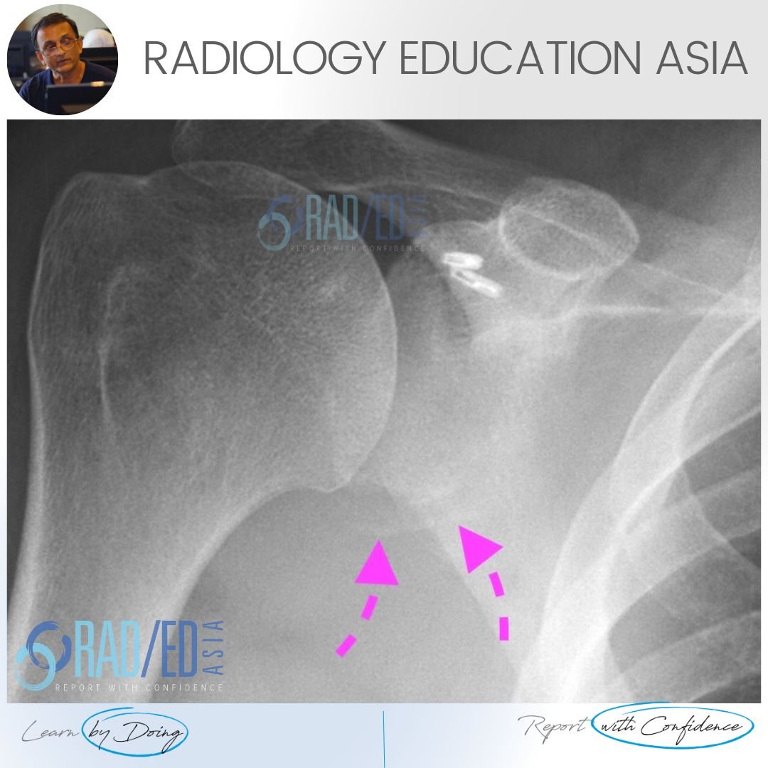 shoulder dislocation bony bankart glenoid fracture xray ct radiology