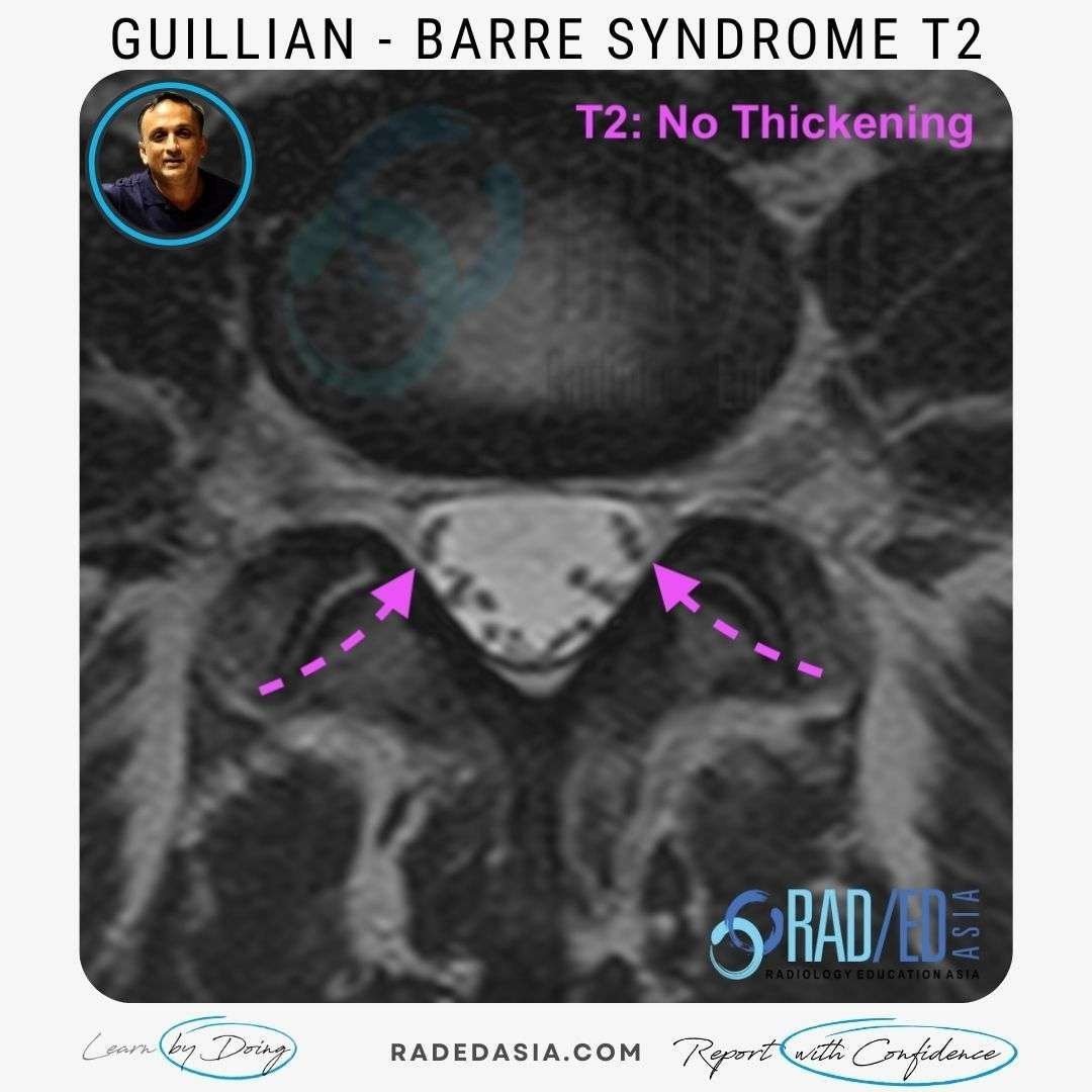 MRI FINDINGS IN GUILLIAN BARRE SYNDROME Radiology Education Asia