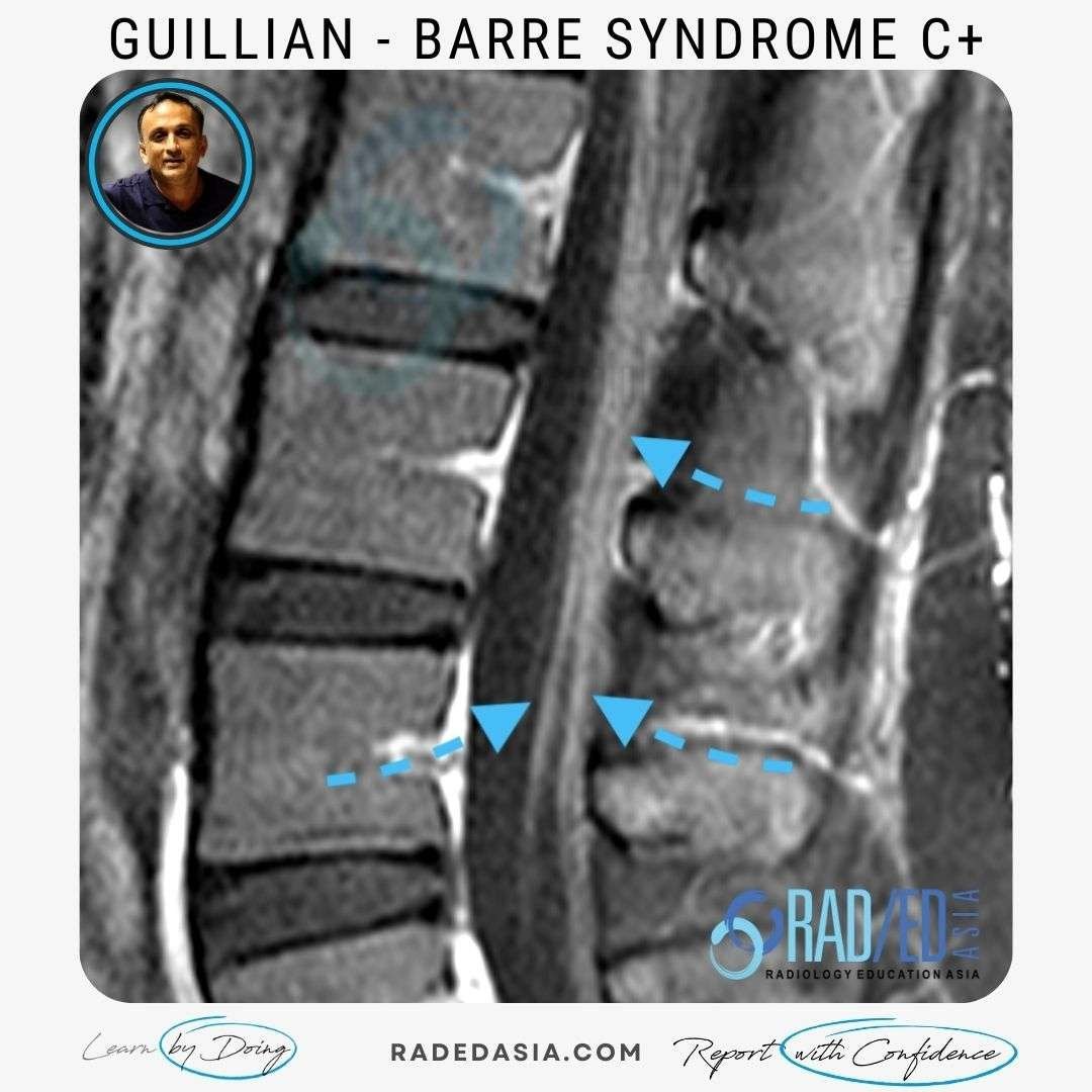 MRI FINDINGS IN GUILLIAN BARRE SYNDROME Radiology Education Asia