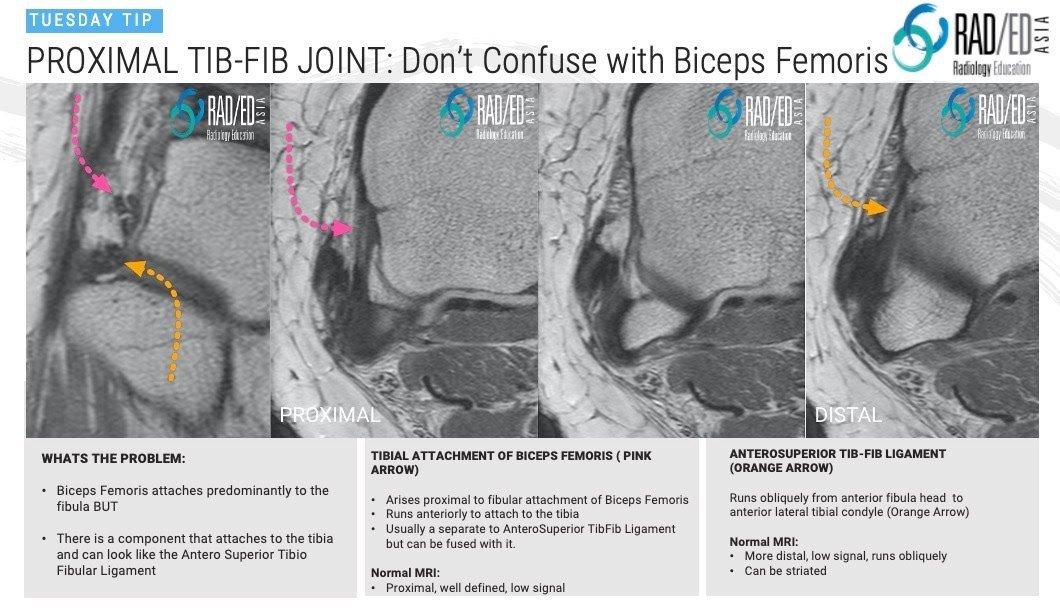 MRI KNEE ANATOMY: PROXIMAL TIBIOFIBULAR JOINT - Radiology Education Asia