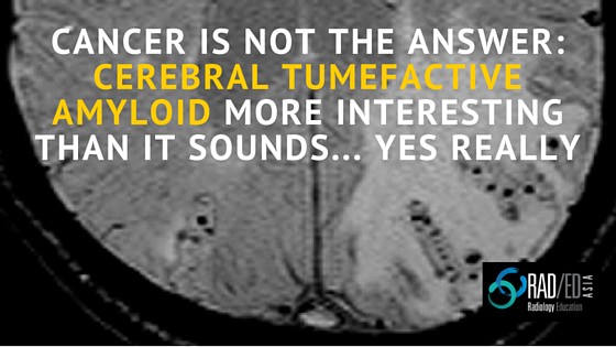 tumefactive-cerebral-amyloid-mri