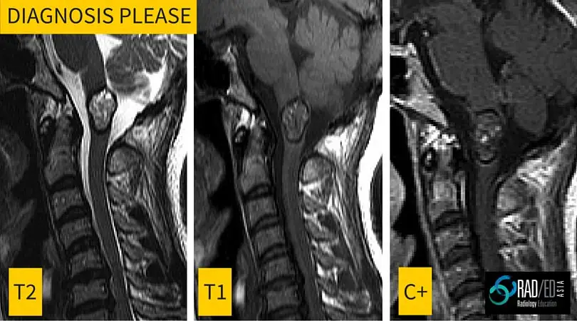 cavernoma-cord-mri-radiology-education-radedasia