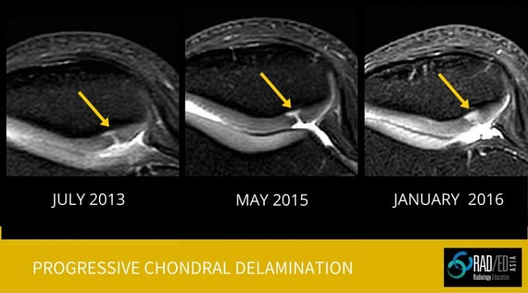 Chondral Delamination MRI: Quick Review - Radedasia