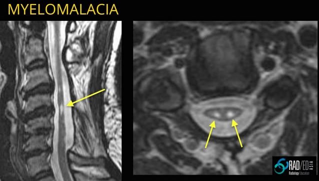 What Is Myelopathy Of The Lumbar Spine - Apa yang Baru? 1