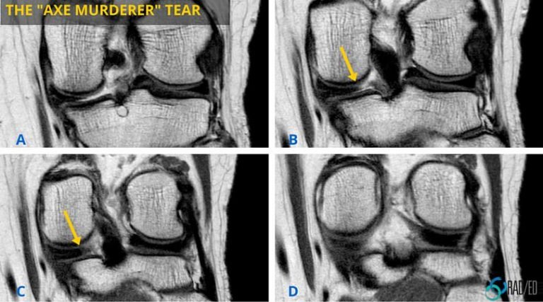 meniscus root tear psterior horn