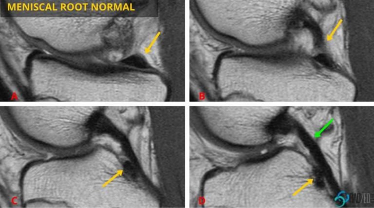 meniscal root sagittal normal radiology education asia