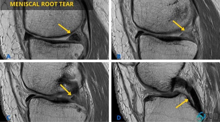 meniscal posterior horn tear sagittal