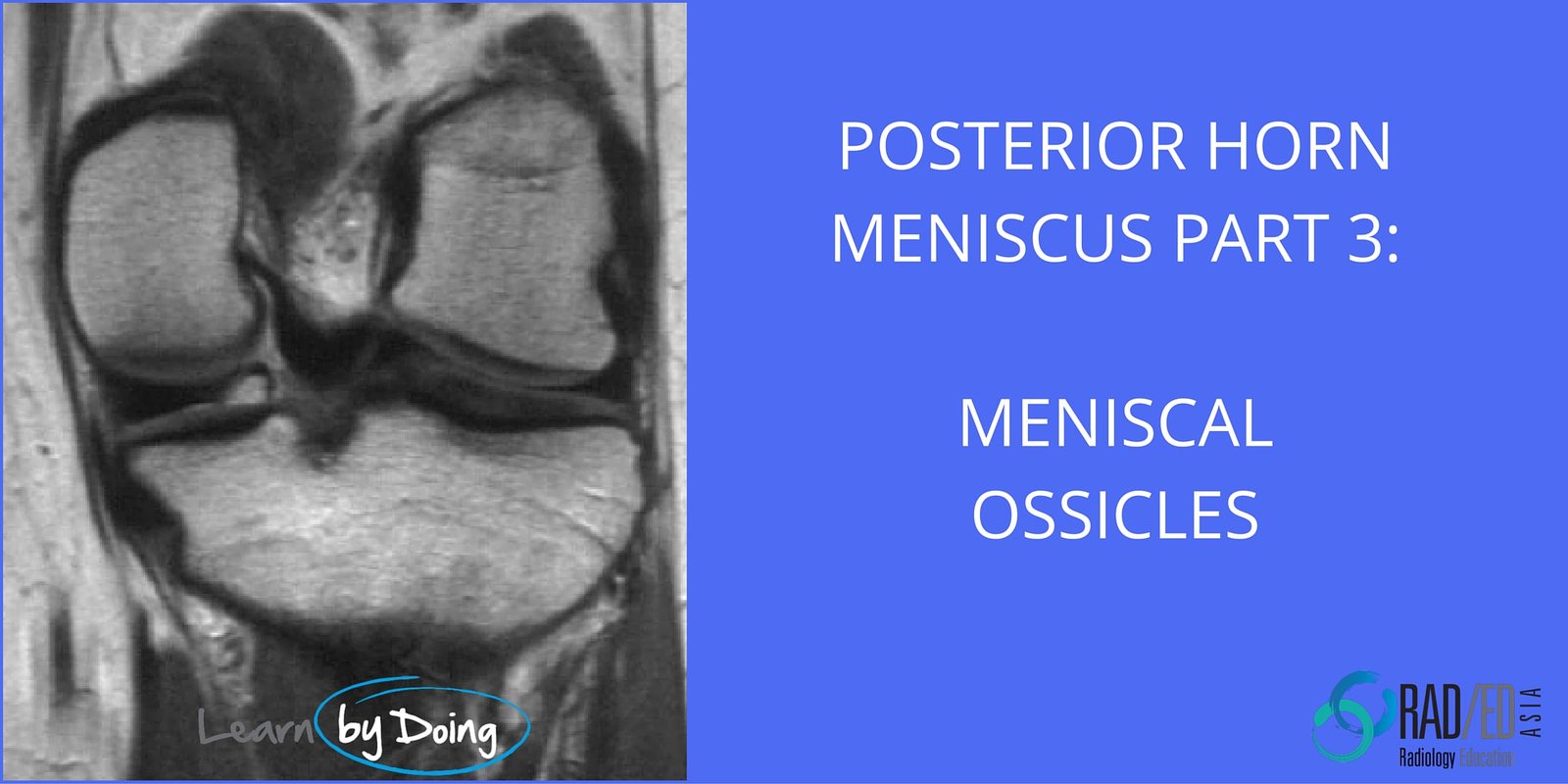 meniscal ossicles mri knee radiology education asia