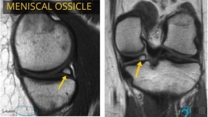 Meniscal Ossicles: Posterior Horn Meniscus Part 3 - Radedasia