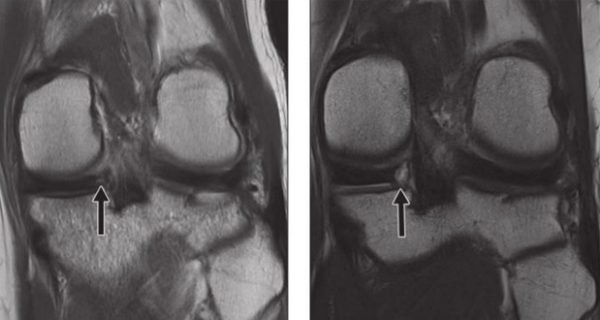 MENISCAL OSSICLES MRI: POSTERIOR HORN MENISCUS (Updated 2021) - Radedasia