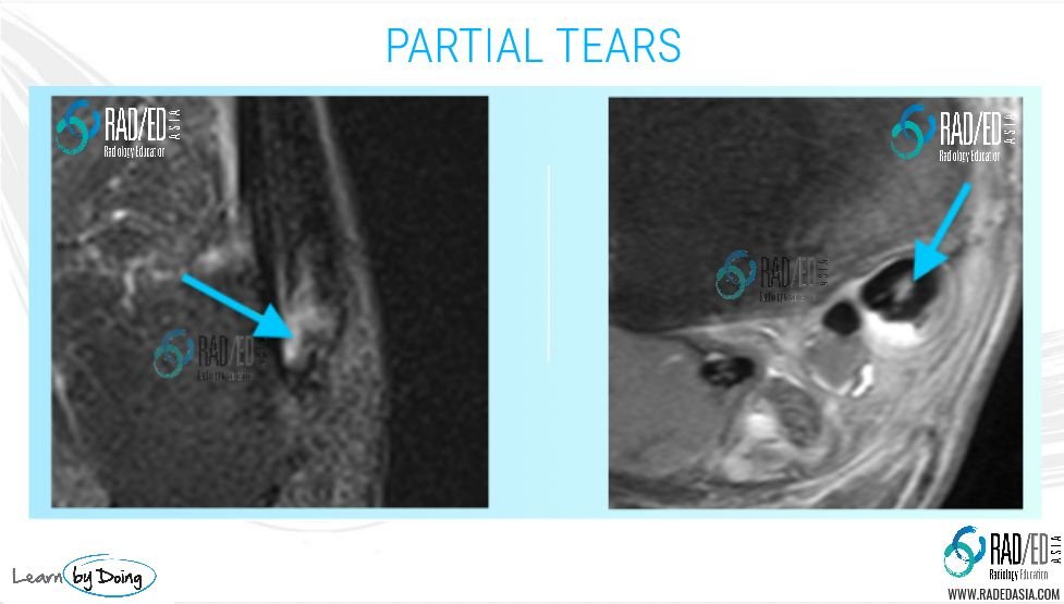 mri of a torn tendon foot