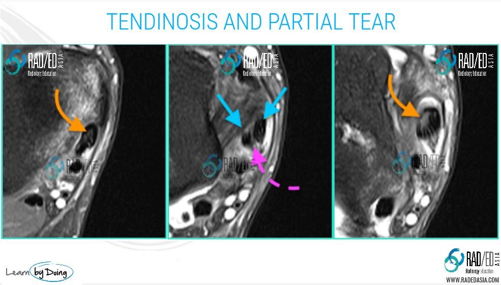 mri of a torn tendon foot