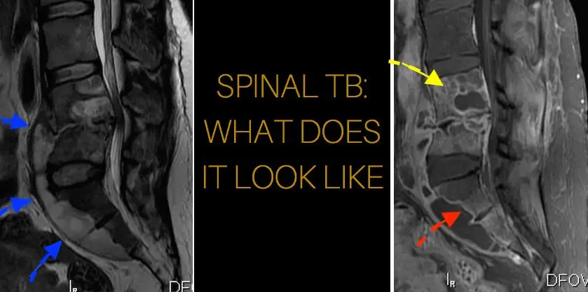 mri-infection-spinal-tb-appearance-tuberculosis-radiology-radedasia