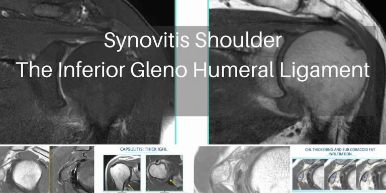 Mri Synovitis Specific Sites In The Shoulder The Inferior Glenohumeral Ligament Radedasia