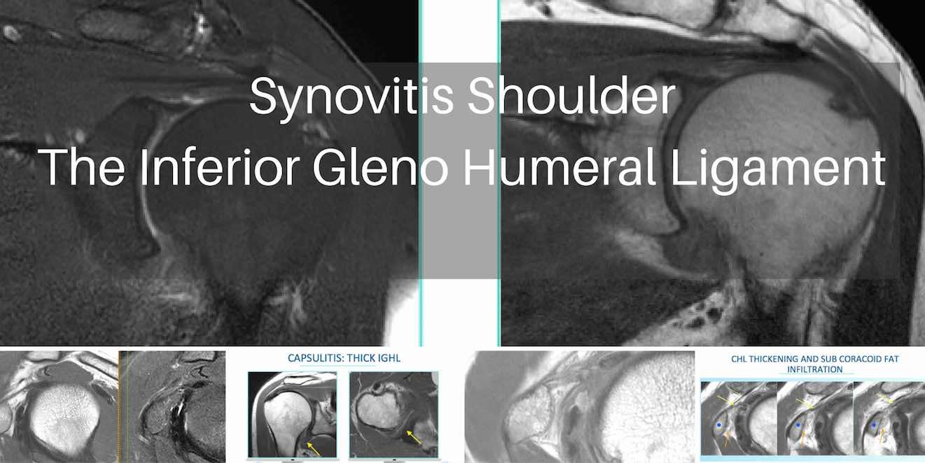 MRI Synovitis Specific sites in the Shoulder: The Inferior GlenoHumeral