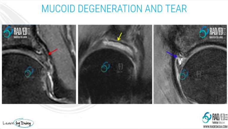 Hip Acetabular Labrum MRI More than just tears: Mucoid Degeneration ...