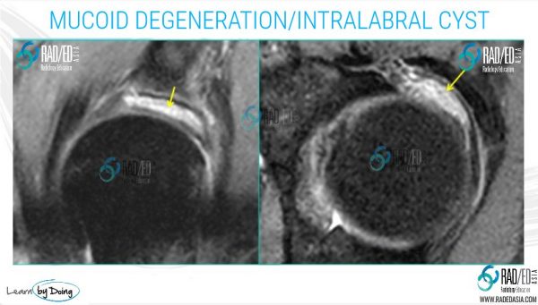 Hip Acetabular Labrum MRI More than just tears: Mucoid Degeneration ...