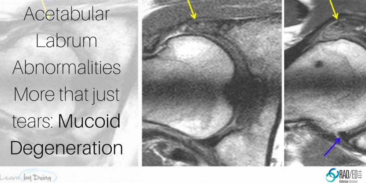 Hip Acetabular Labrum MRI More than just tears Mucoid Degeneration