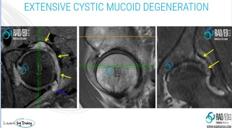 Hip Acetabular Labrum MRI More than just tears: Mucoid Degeneration ...