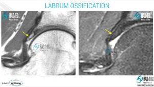 HIP LABRUM OSSIFICATION MRI: LABRAL ABNORMALITIES MORE THAN JUST TEARS ...