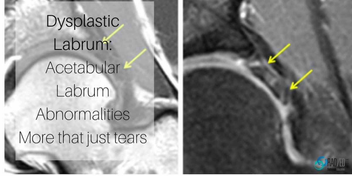 Hip Dysplastic Labrum Mri Acetabular Labrum More Than Just Tears Part 3 Radedasia 1368