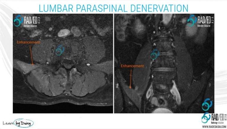 acute-denervation-lumbar-paraspinal-mri-radiology-education-asia-radedasia.