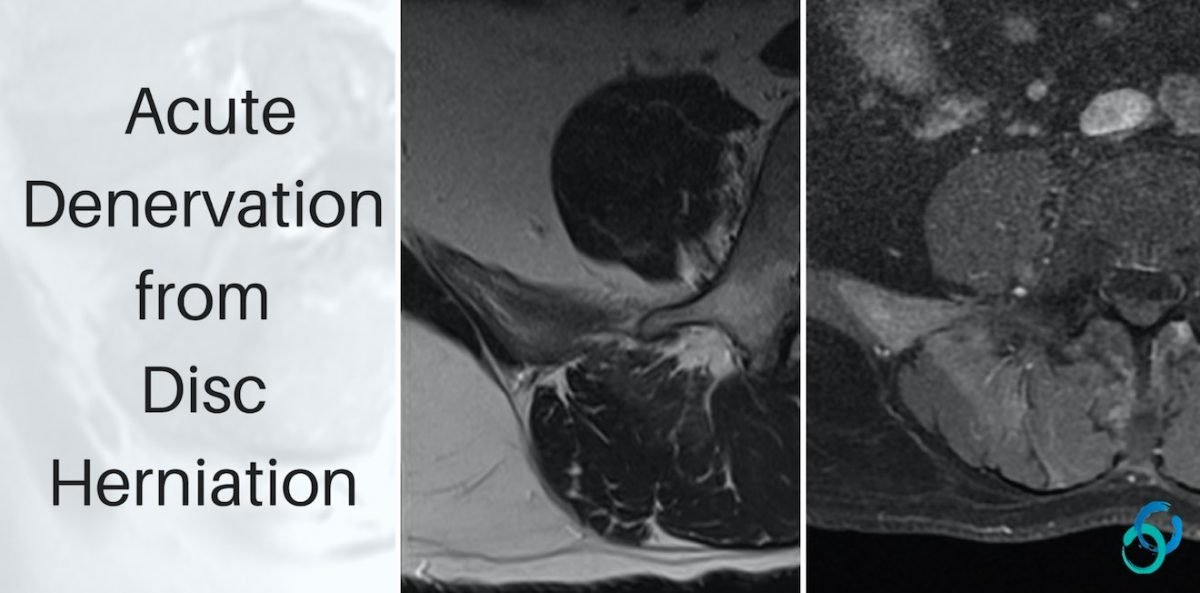 MRI LUMBAR: DISC HERNIATION & ACUTE DENERVATION - Radedasia