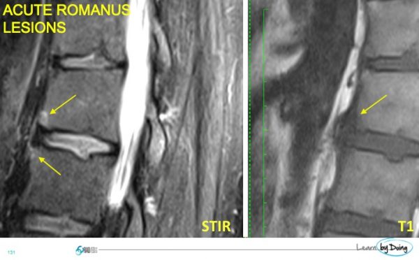 The Romanus Lesion: Why, Where and What - Radedasia