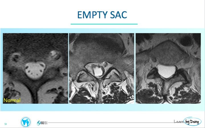 Arachnoiditis Patterns on MRI - Radedasia