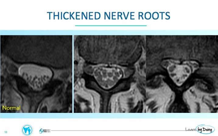 arachnoiditis mri thick nerve roots