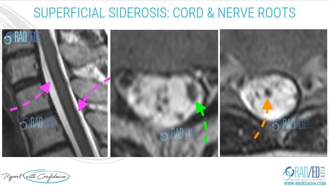 superficial siderosis mri cord spine nerve root radedasia