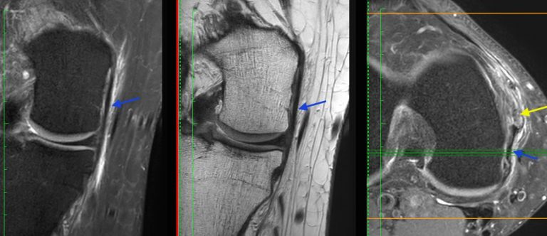 MRI Knee MCL Tear what else to look for – Radiology Education Asia