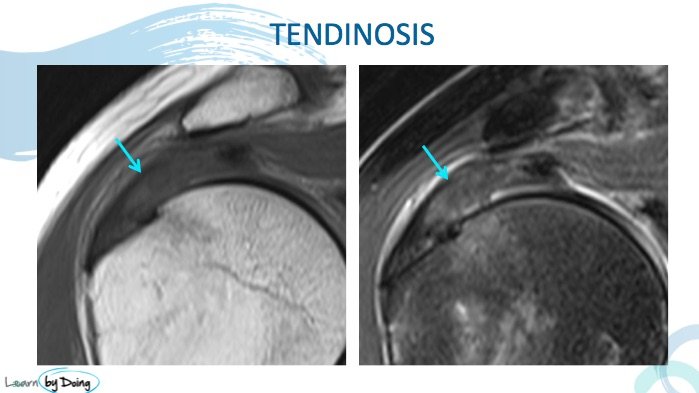 MRI Rotator Cuff Tendinosis Vs Tears - Radedasia